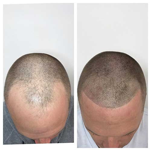 Scalp Micropigmentation