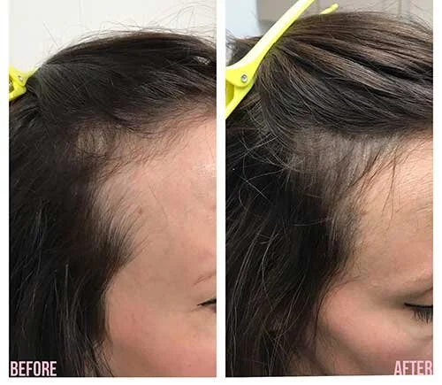 thinning hair balding treatment for women in oklahoma city | micropigmentation hairline tattoo for women | primeline okc