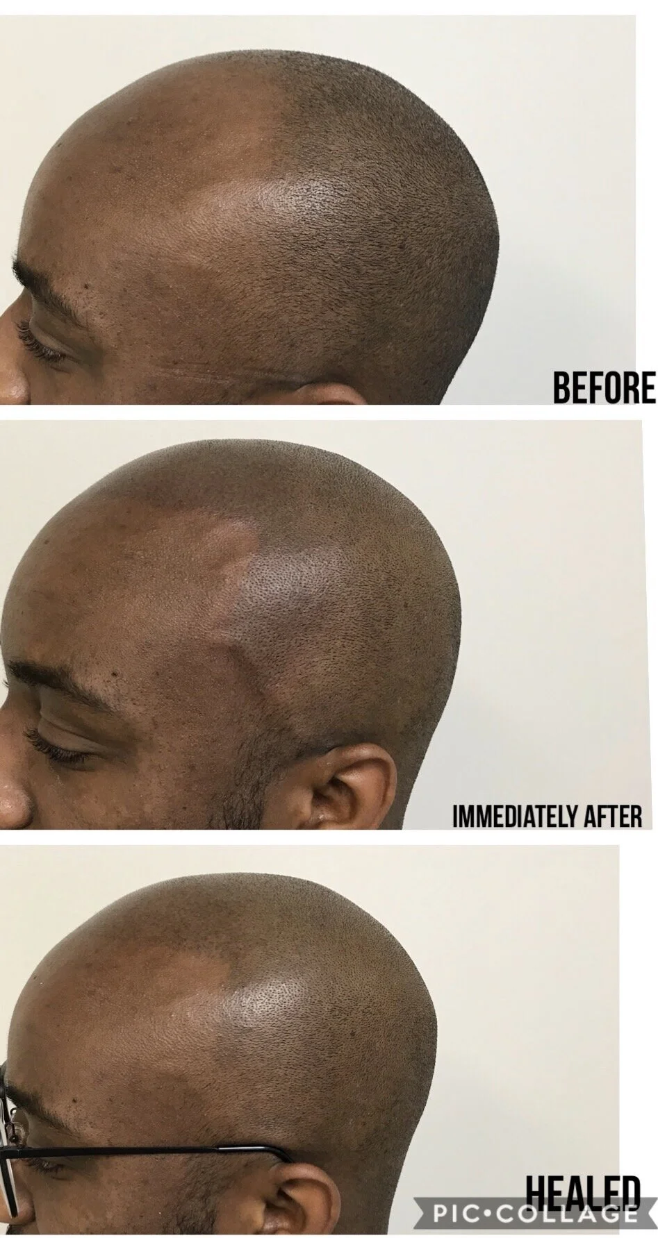 before and after pictures scalp micropigmentation | SMP healing | SMP OKC