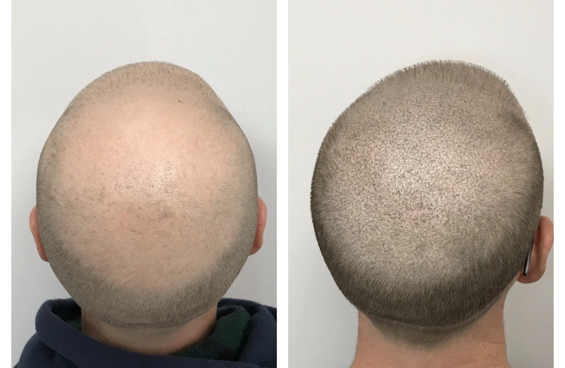 scalp micropigmentation aftercare | thinning hair | thinning hair on top of head