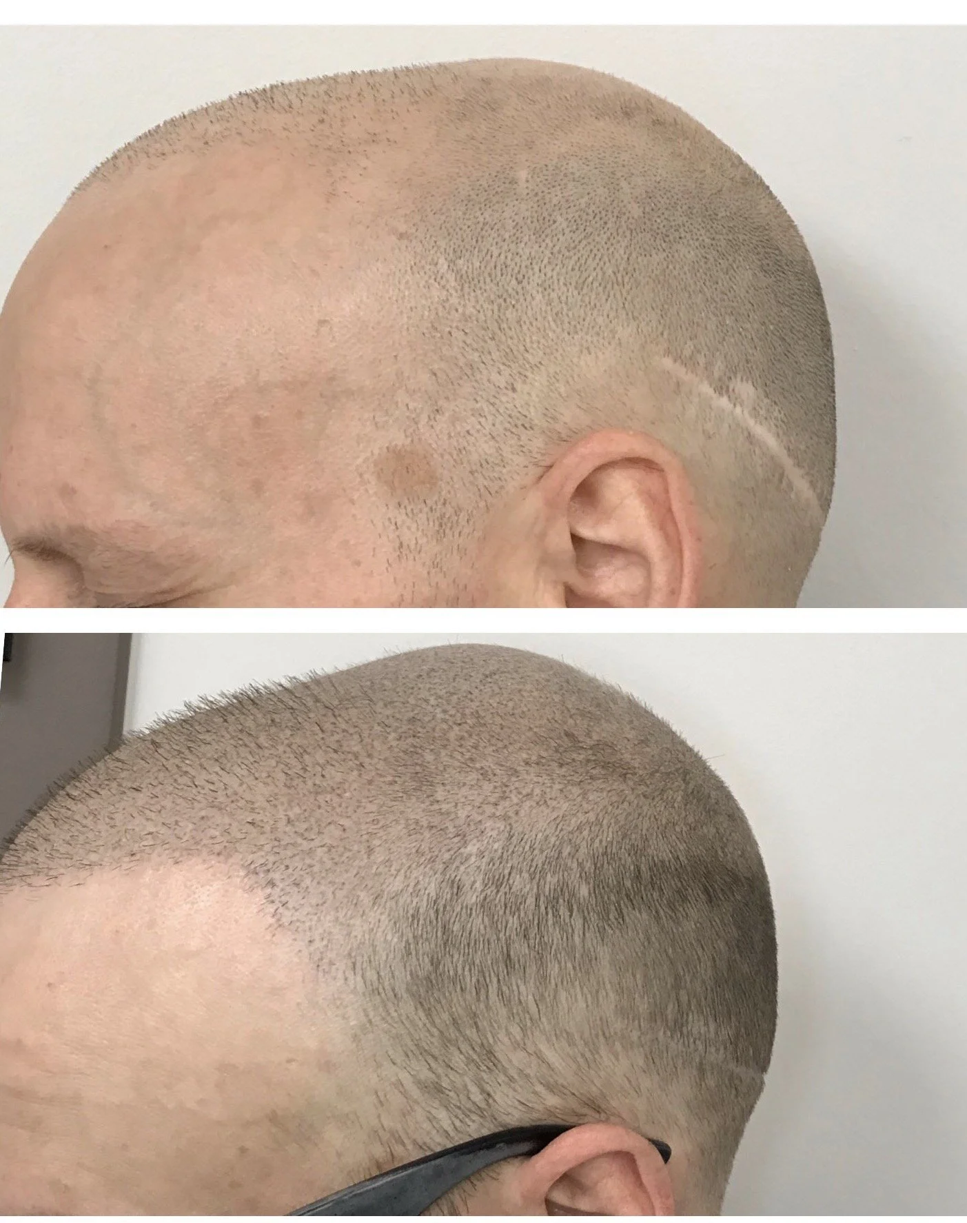 thinning hairline | thinning hair men | Prime Line OKC scalp micropigmentation 