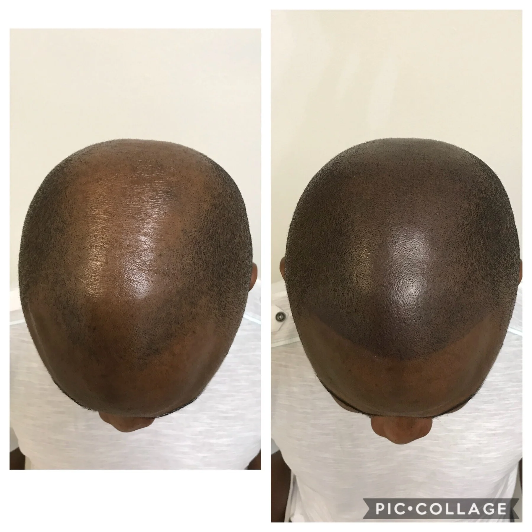 scalp micropigmentation full scalp | hair tattoo | scalp Tattoo | okc metro | norman, ok | lawton, ok 