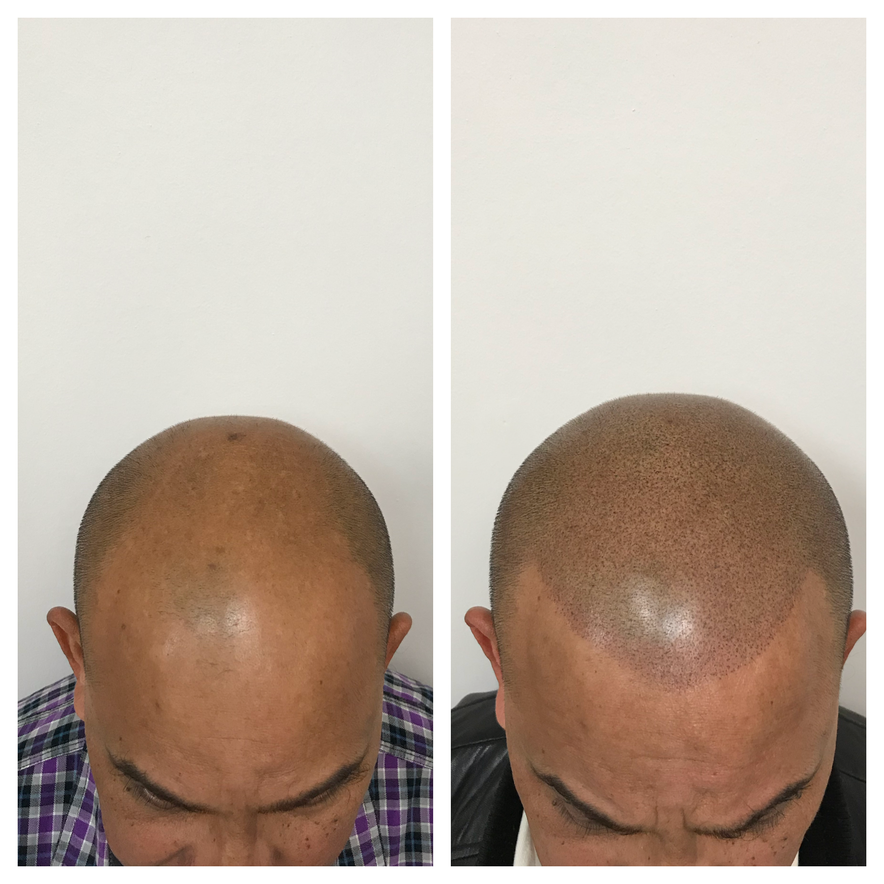 Oklahoma scalp micropigmentation | balding spots on on scalp | balding cure 