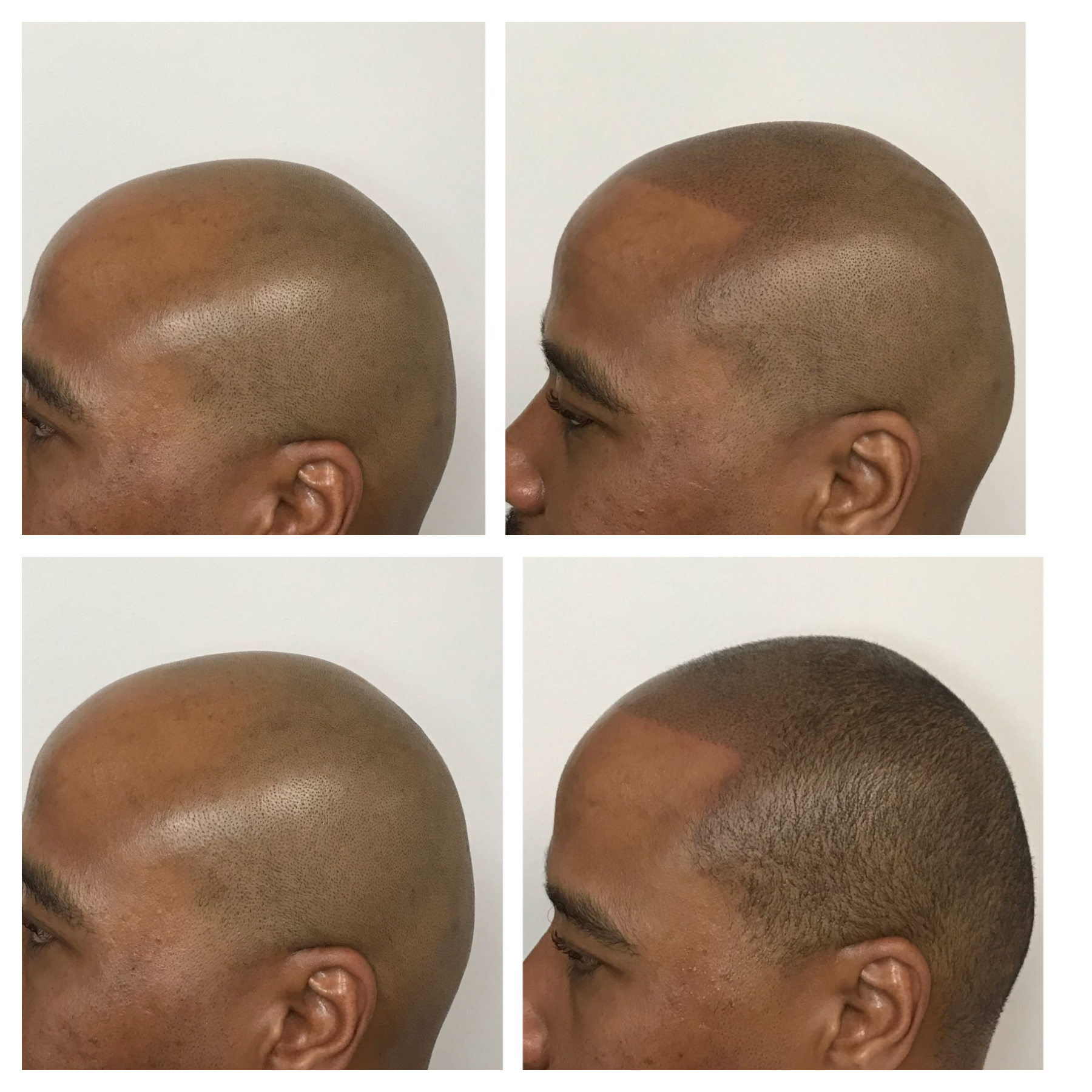 balding haircuts | balding scalp | hair tattoo | Clinton, Ok | Elk City, OK | Woodward, OK 