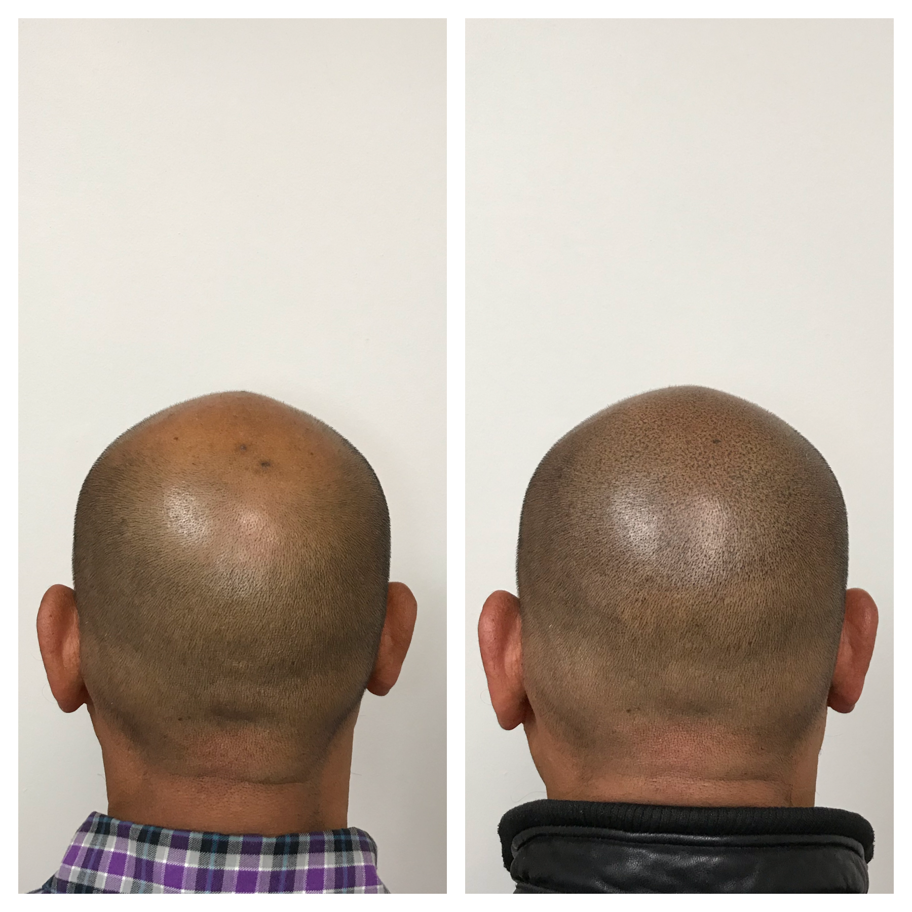 balding scalp | balding treatment | balding men | Oklahoma scalp micropigmentation 