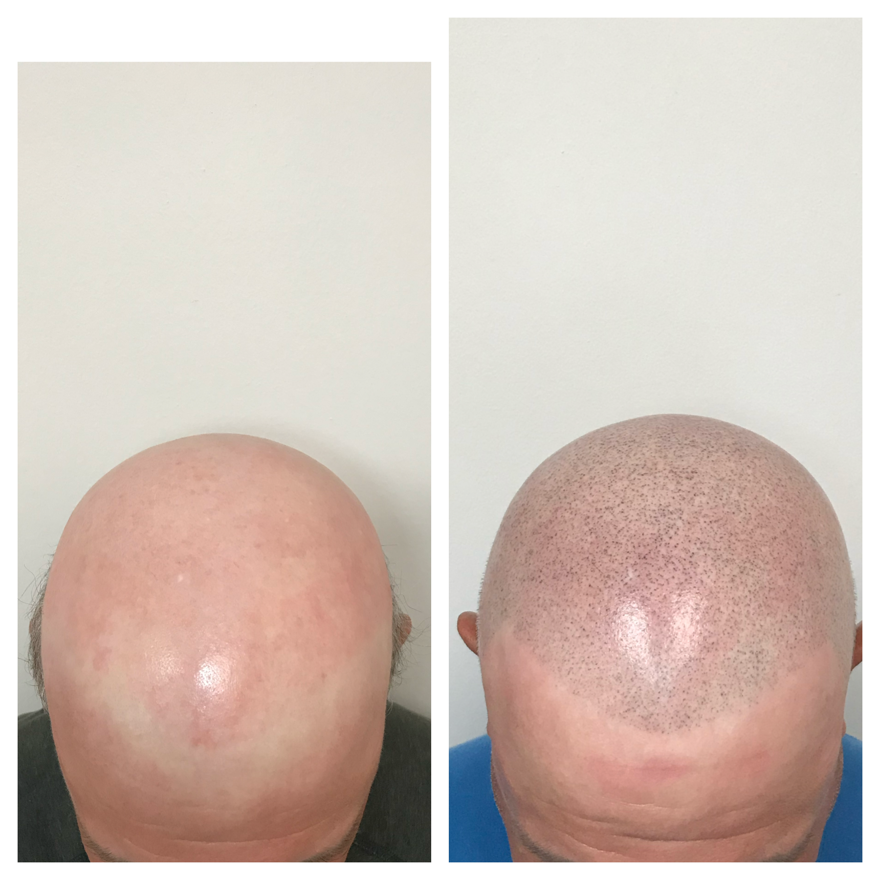 hair micropigmentation | hair loss | hair scalp | prime line okc SMP 