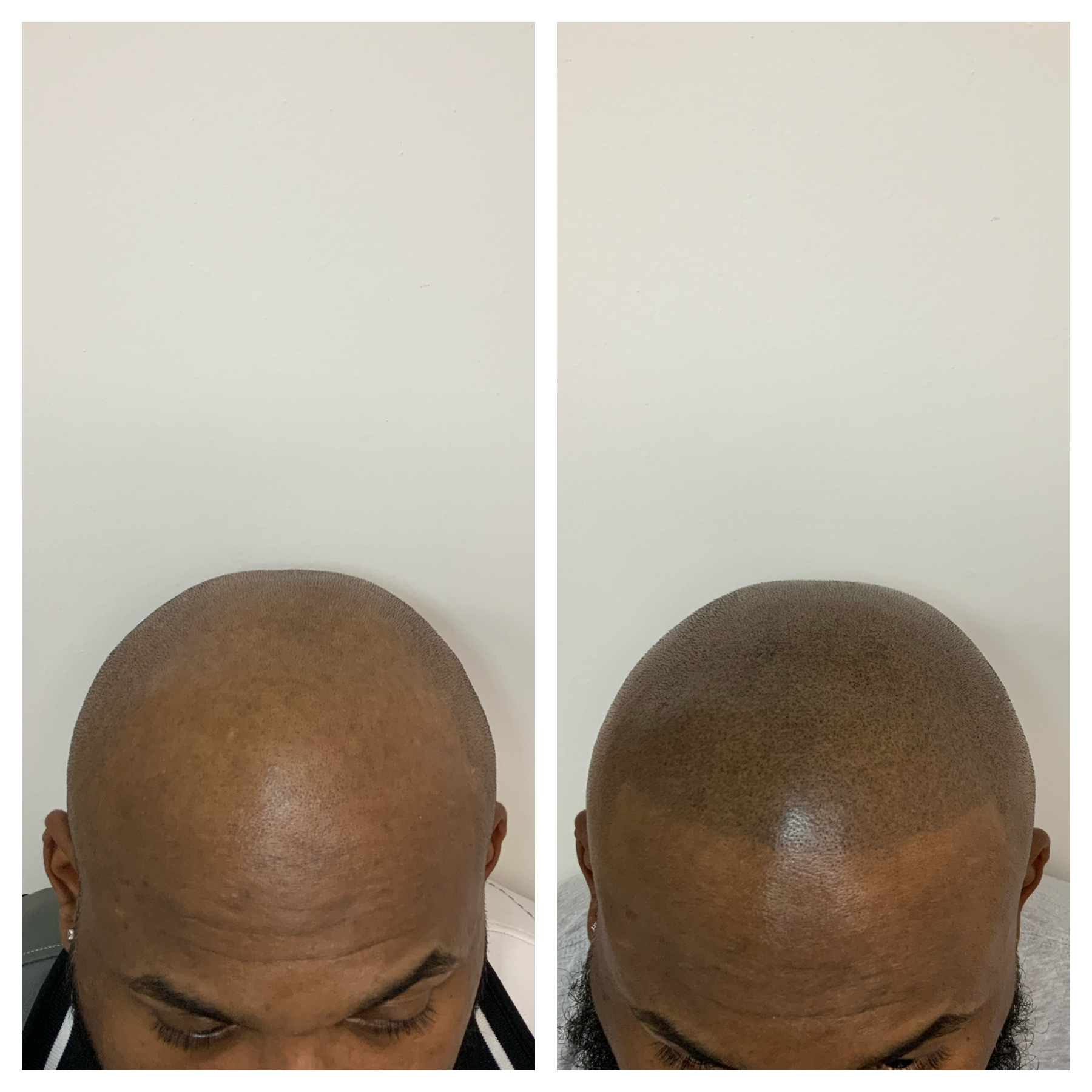 new hairline | balding on top of head | hair solution | prime line okc 
