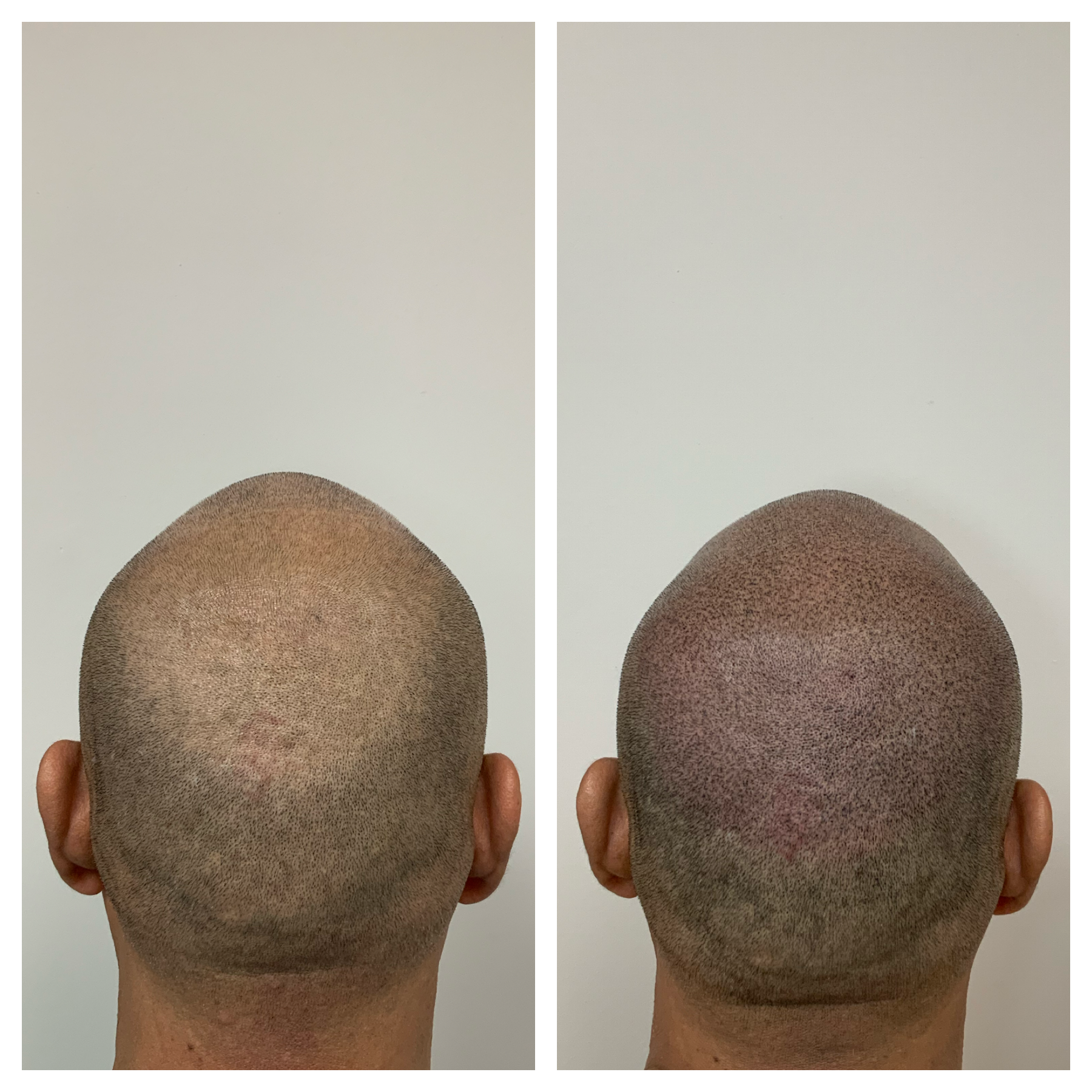 hair restoration okc | hair scalp tattoo | hair tattoo scalp micropigmentation 