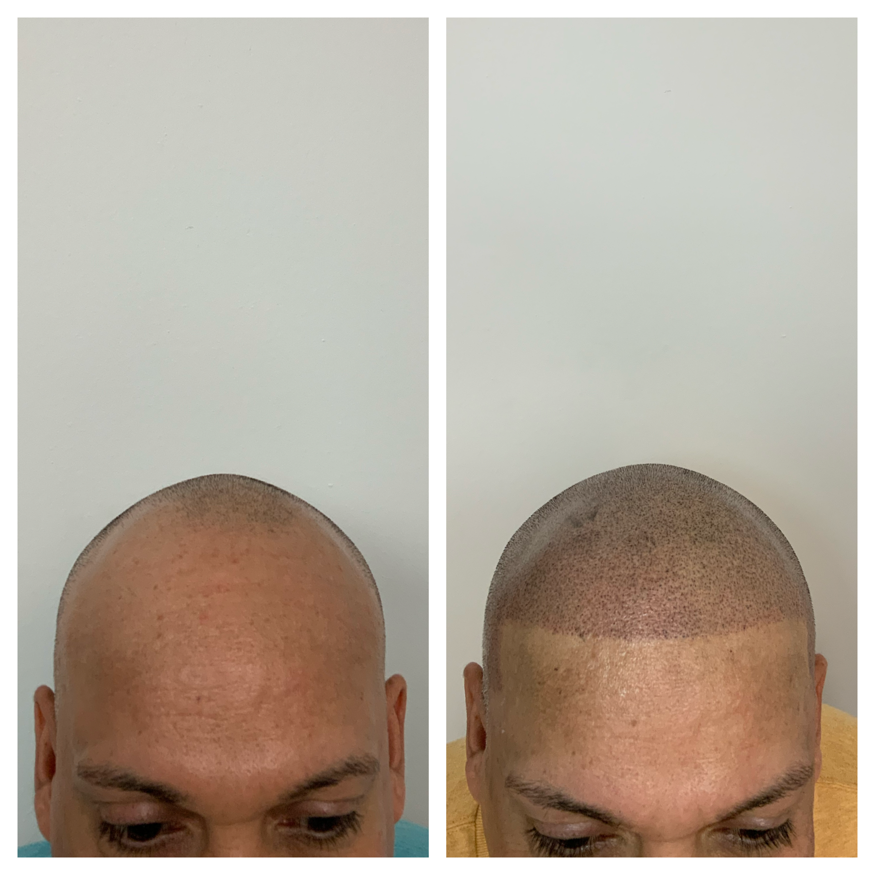 prime line okc scalp micropigmentation | Erin Meier | 