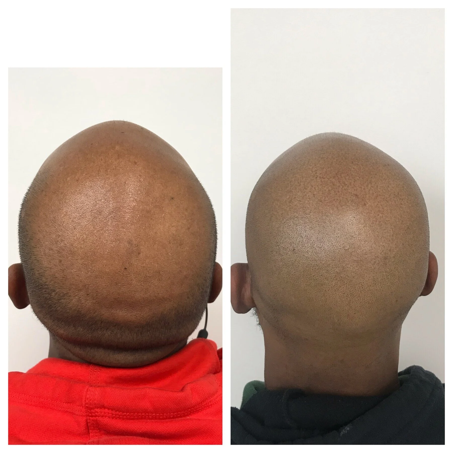 natural hairline | balding hair treatment | balding hairstyles | prime Line okc 