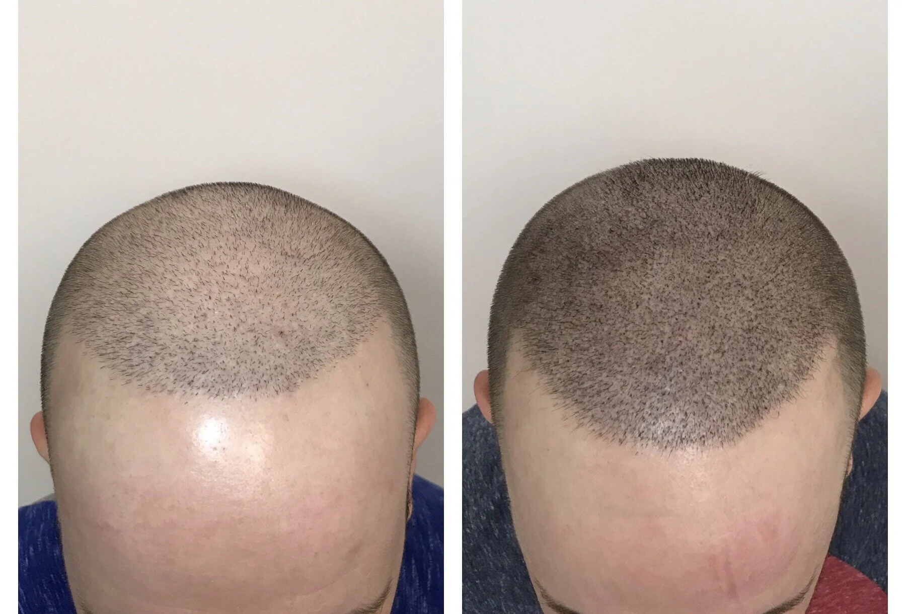 Restore hair density with SMP | Tulsa, Broken Arrow, Bartlesville, Ok 