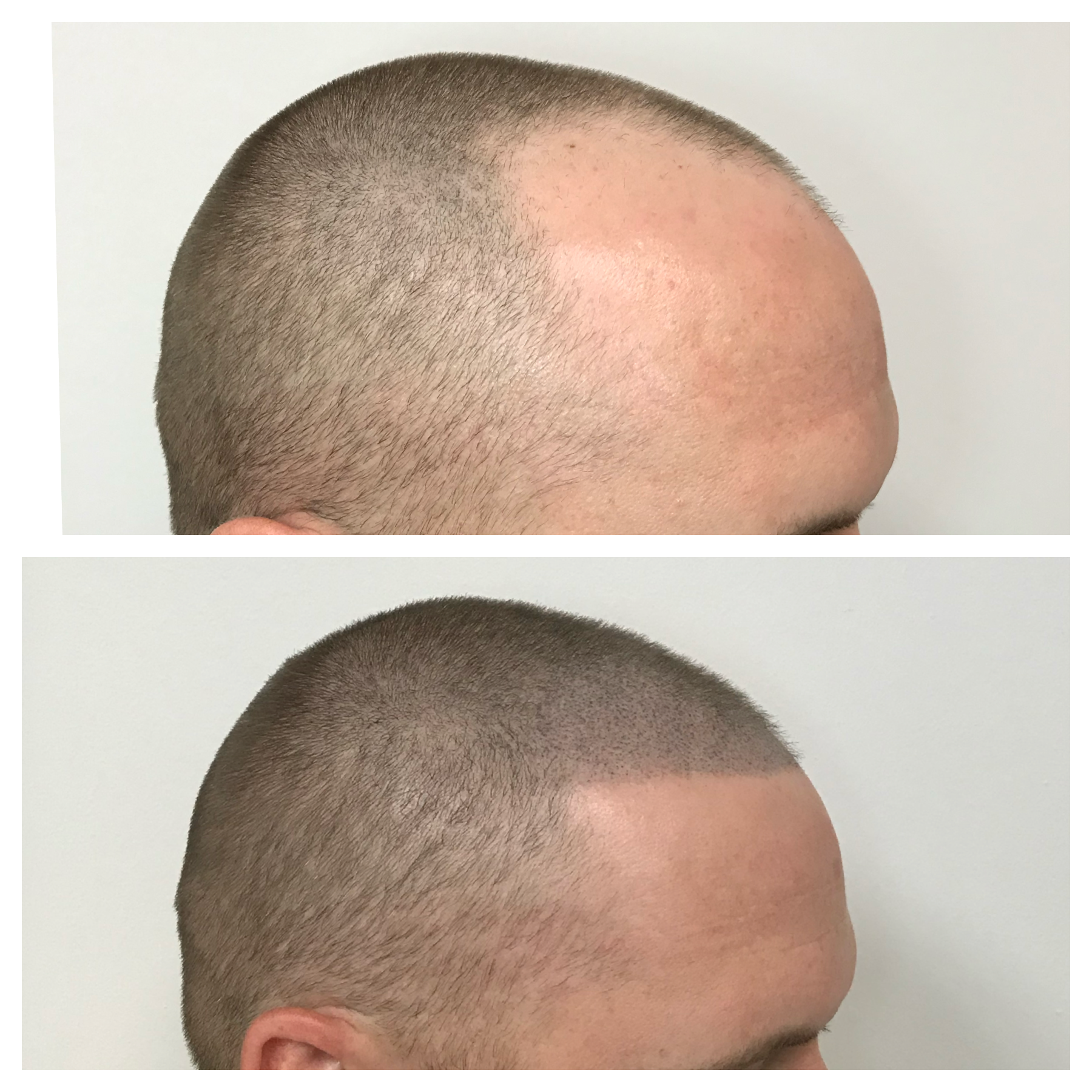 Scalp Tattoo hairline | scalp tattoo for thinning hair | Prime Line Okc 