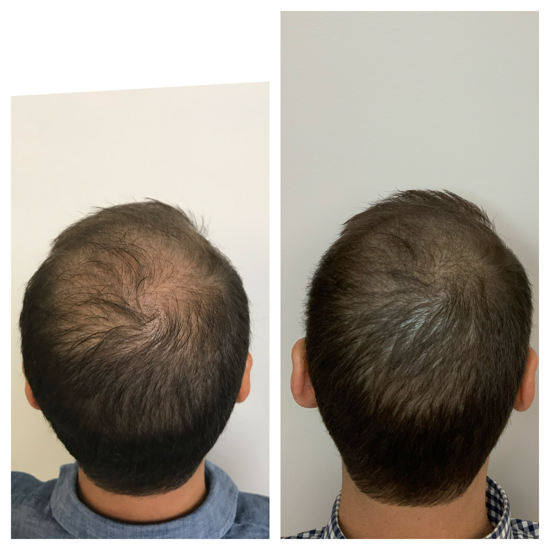hair tattoo in oklahoma | defy hair loss | bald spots 