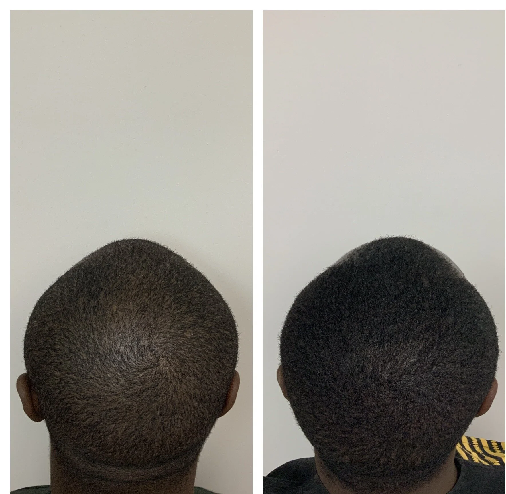 thinning hair men | thinning hairline | lawton, tulsa, stillwater, ok 