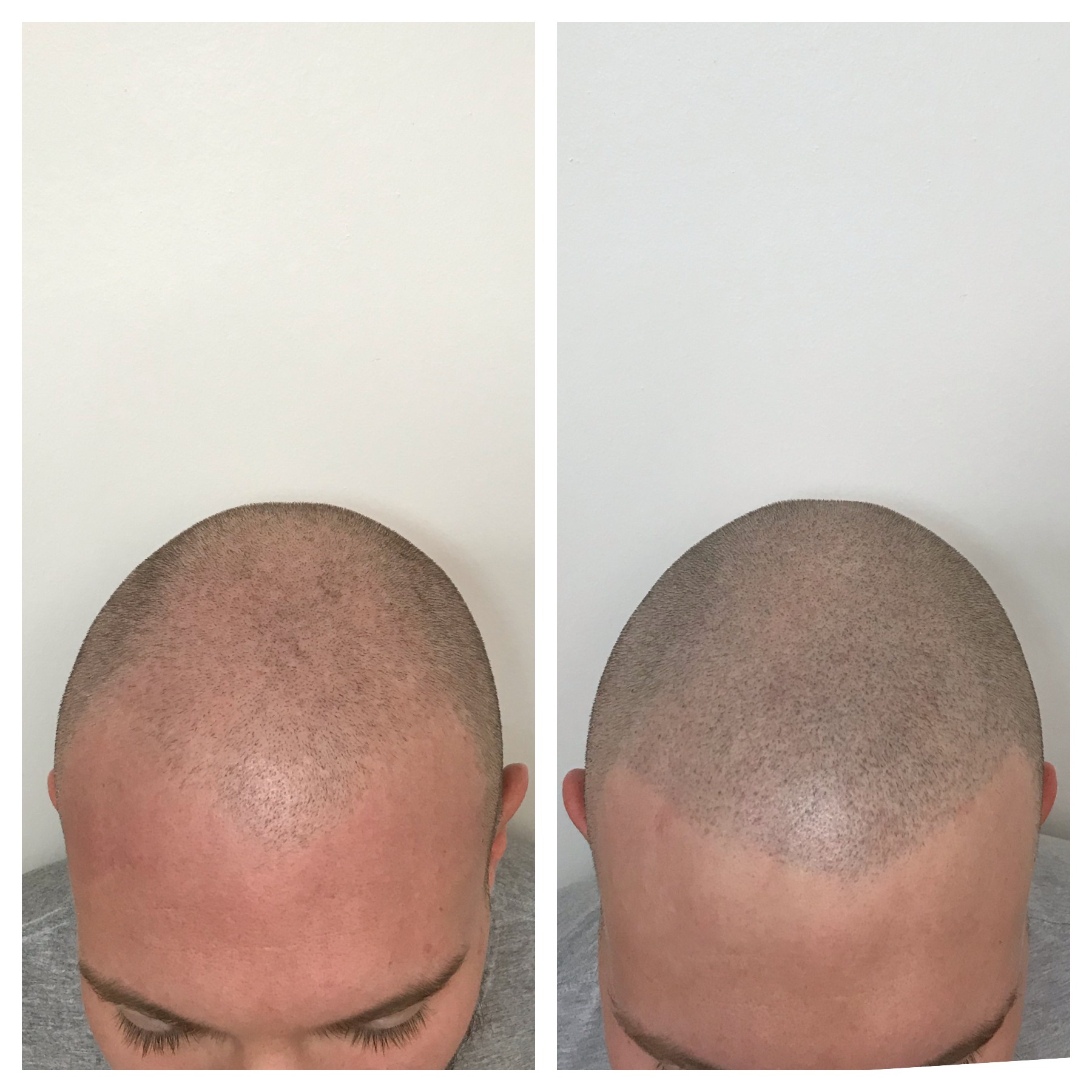 hair tattoo | scalp tattoo | scalp micropigmentation Oklahoma 