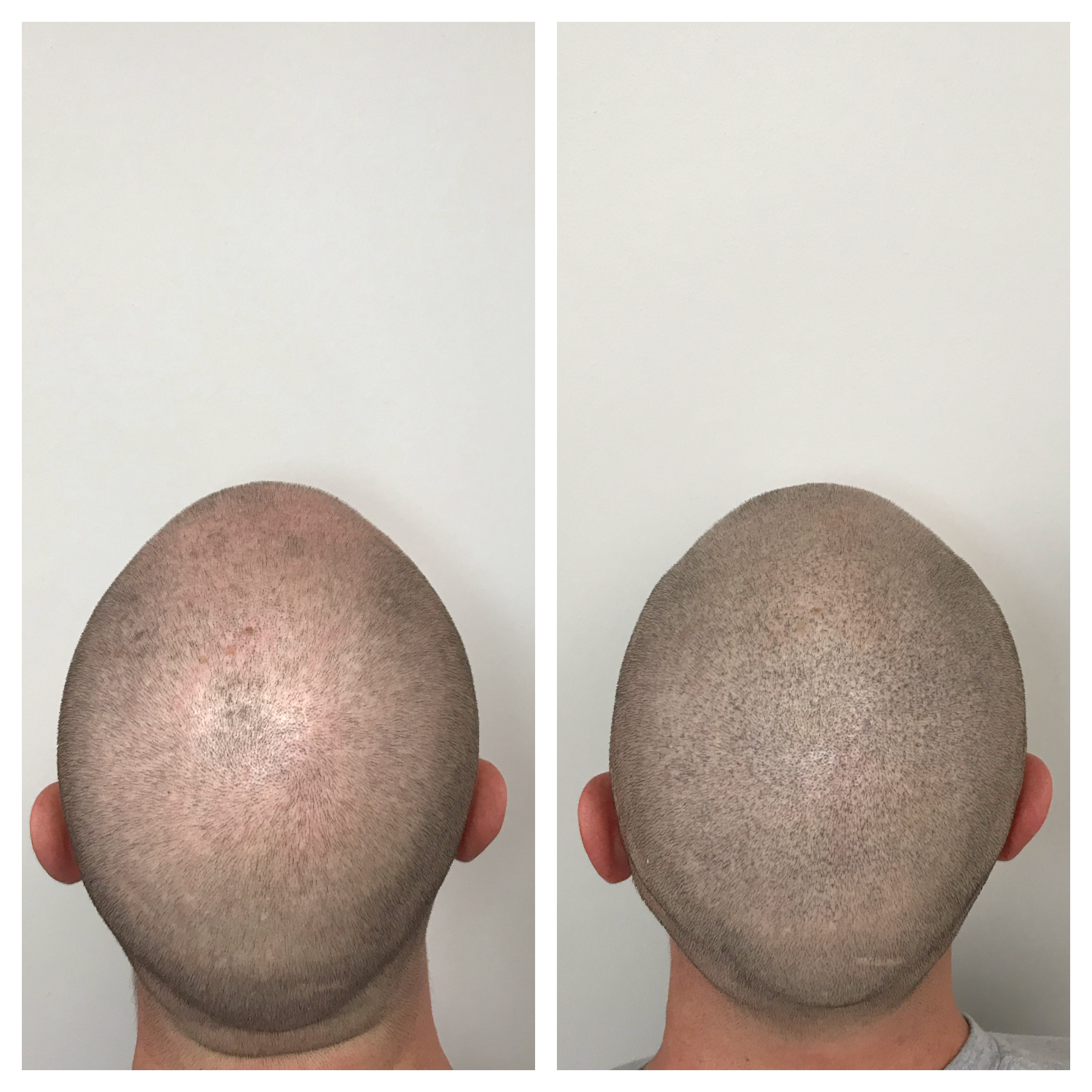 non surgical hair restoration | restore your hairline with SMP 