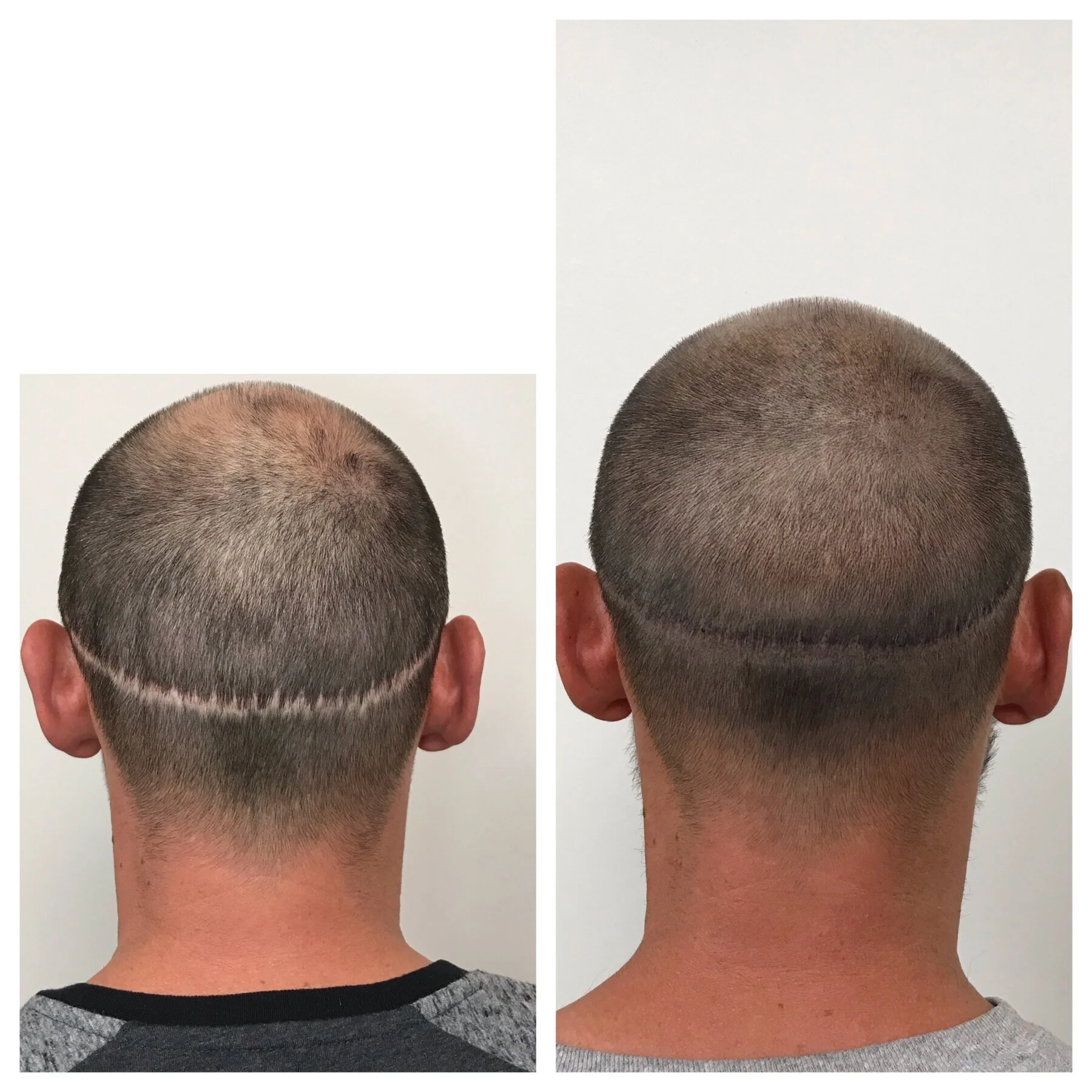 hair transplant | hair transplant scar tattoo | hair transplant scar camouflage | prime line okc 