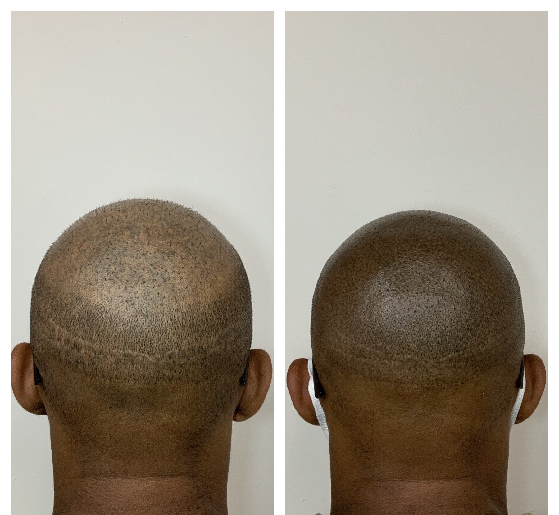 scar revision | scar after hair transplant | SMP for scar camouflage | Oklahoma City, OK 