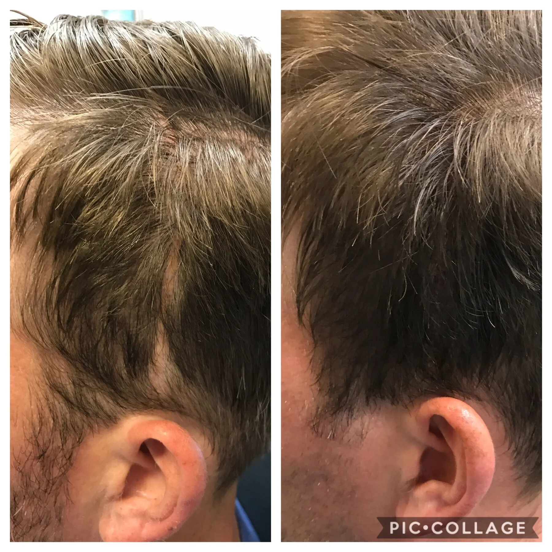 surgical scar camouflage | Scalp Micropigmentation Oklahoma | Scalp scar coverup 