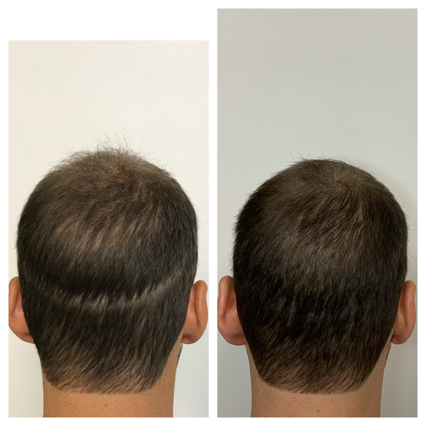 conceal hair transplant scars with SMP | Oklahoma | prime line okc 