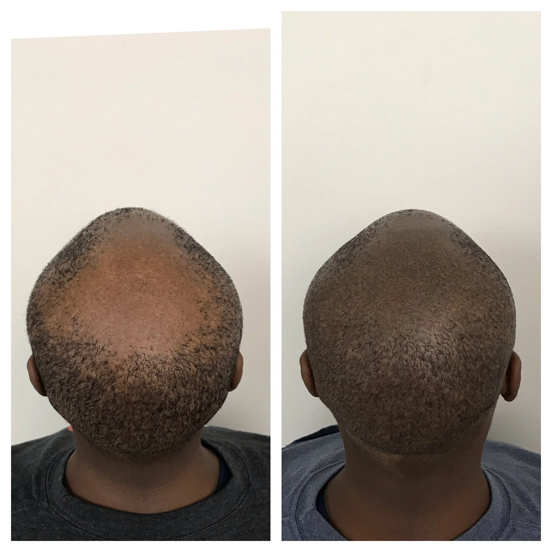 smp for women's hair loss | hair loss in women | hair loss treatment for women | Oklahoma 