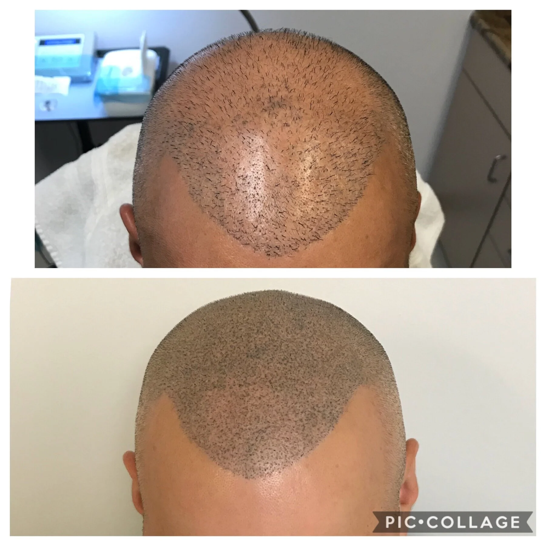 SMP correction | Cosmetic Correction | SMP results | prime line okc| SMP Oklahoma 