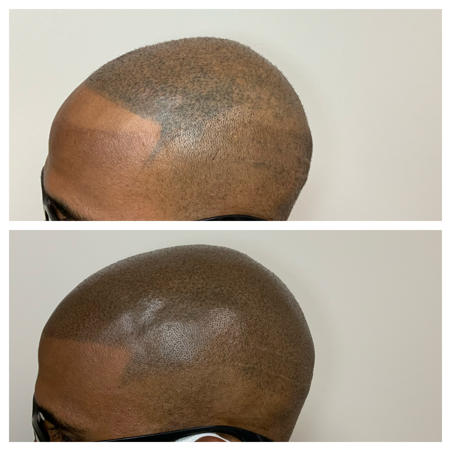 smp touchups | scalp micropigmentation touchup ups | primelineokc.com