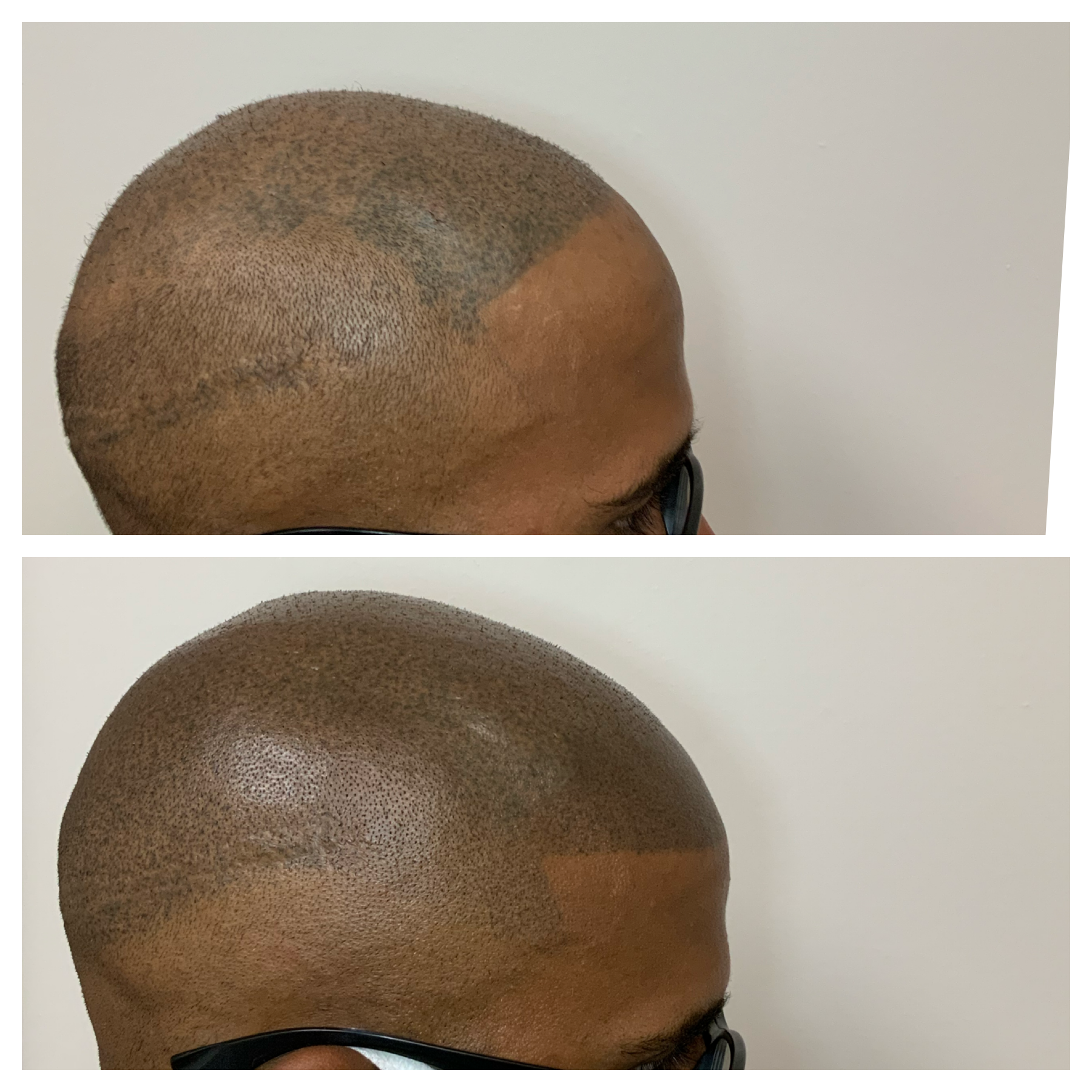 scalp tattoo coverup | scalp tattoo hairline | tattoo micropigmentation | Tulsa, OK 