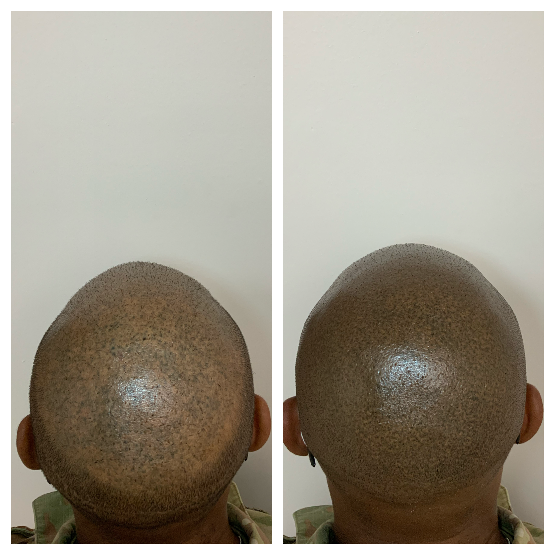 smp cover up | SMP correction | scalp micropigmentation touchups | OKC metro 