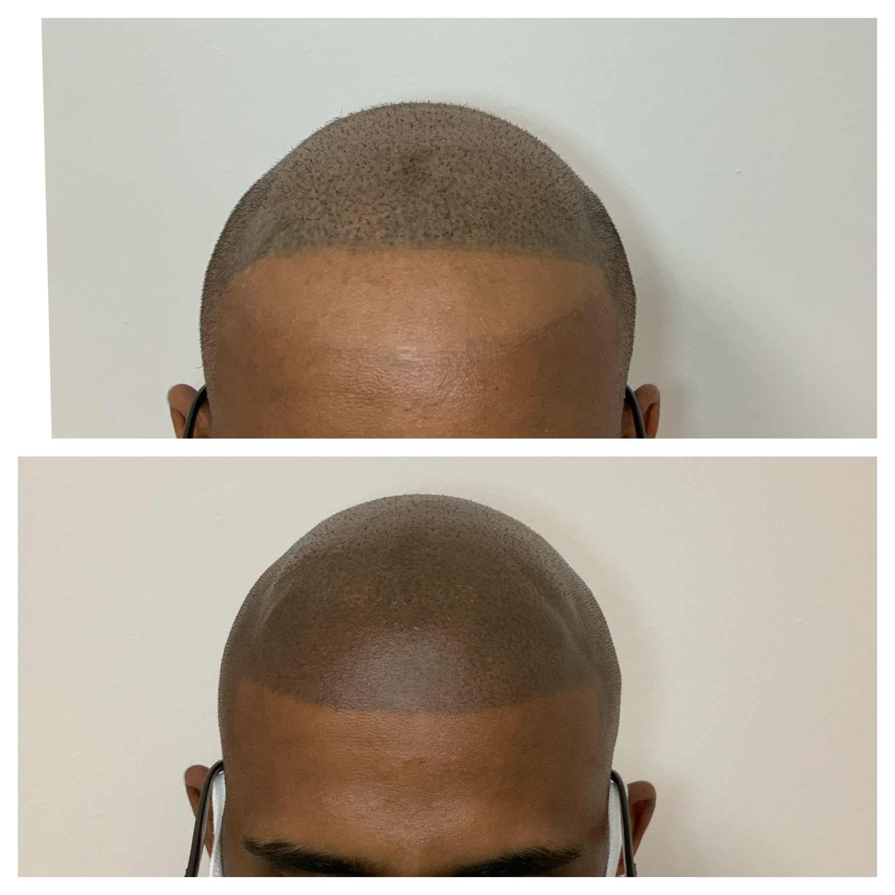 SMP touchup cost | scalp Micropigmentation too dark | Erin Meier | Oklahomas scalp treatment 