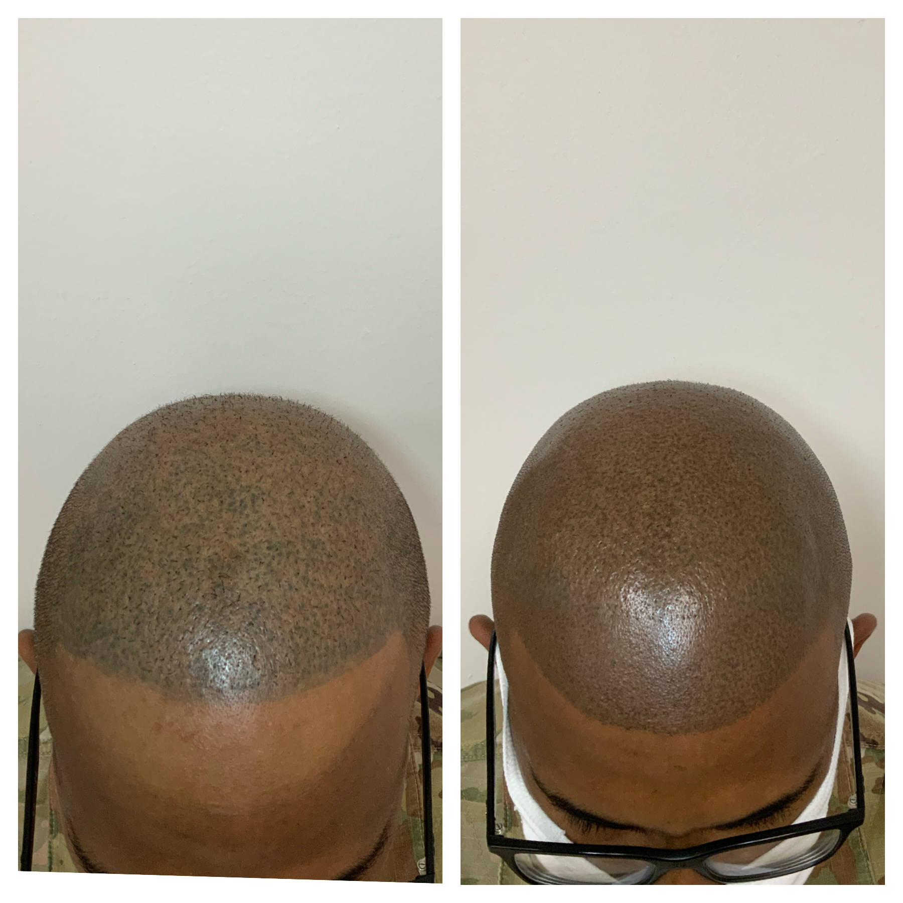 smp touchups and corrections | SMP fading | scalp micropigmentation last | Oklahoma City, OK 