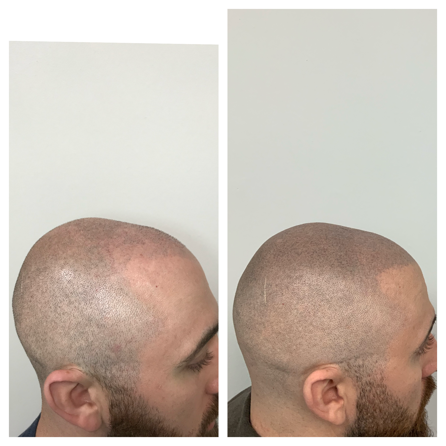 SMP touchup cost | restore natural hairline | prime line okc | 