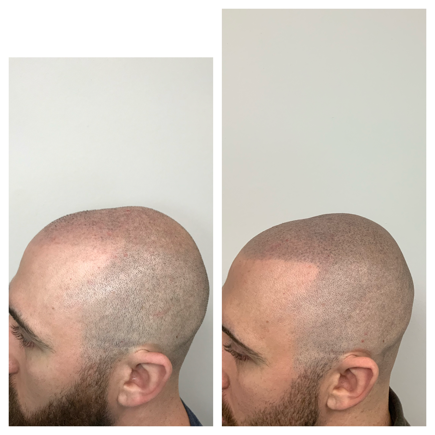 primelineokc.com | scalp tattoo removal | head tattoo fade | head tattoo under hair 