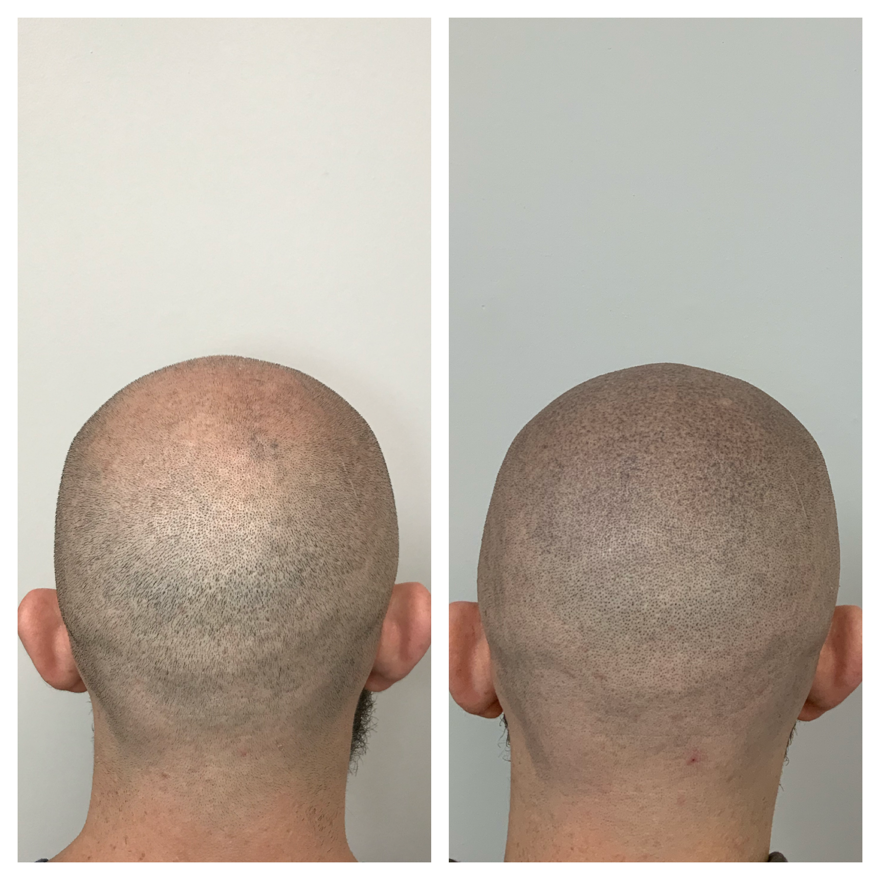 cosmetic pigmentation | hair tattoo cover up | SMP coverup | prime line okc | Mustang, OK | Yukon, OK | Norman, OK 