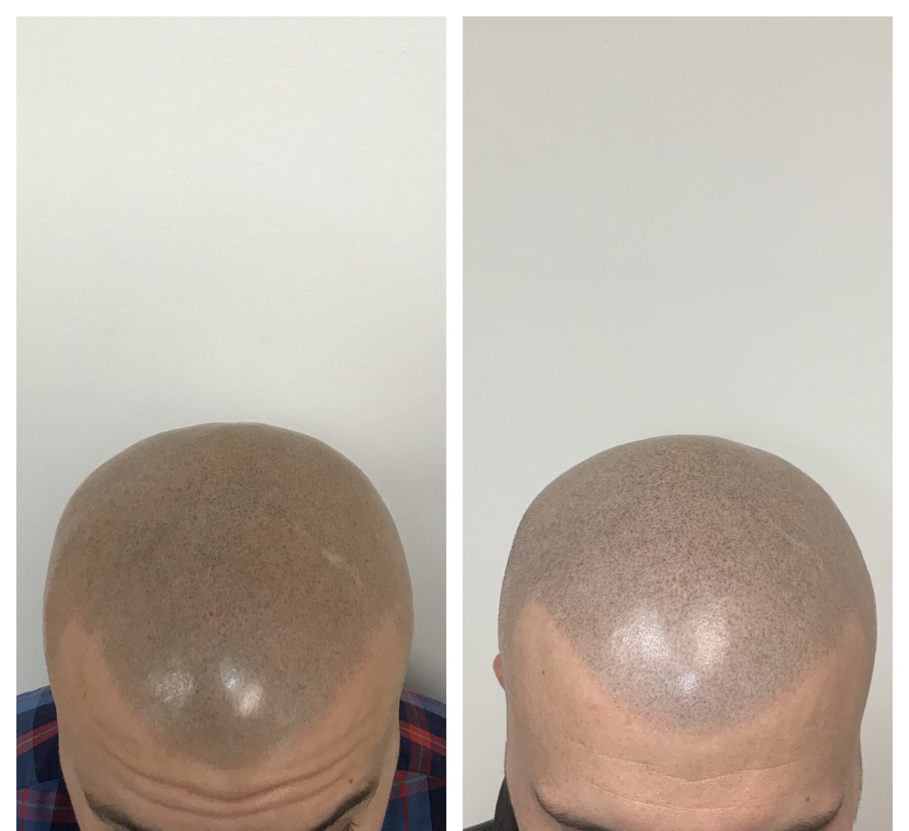 3D scalp Micropigmentation | touchup sessions | smp post care 