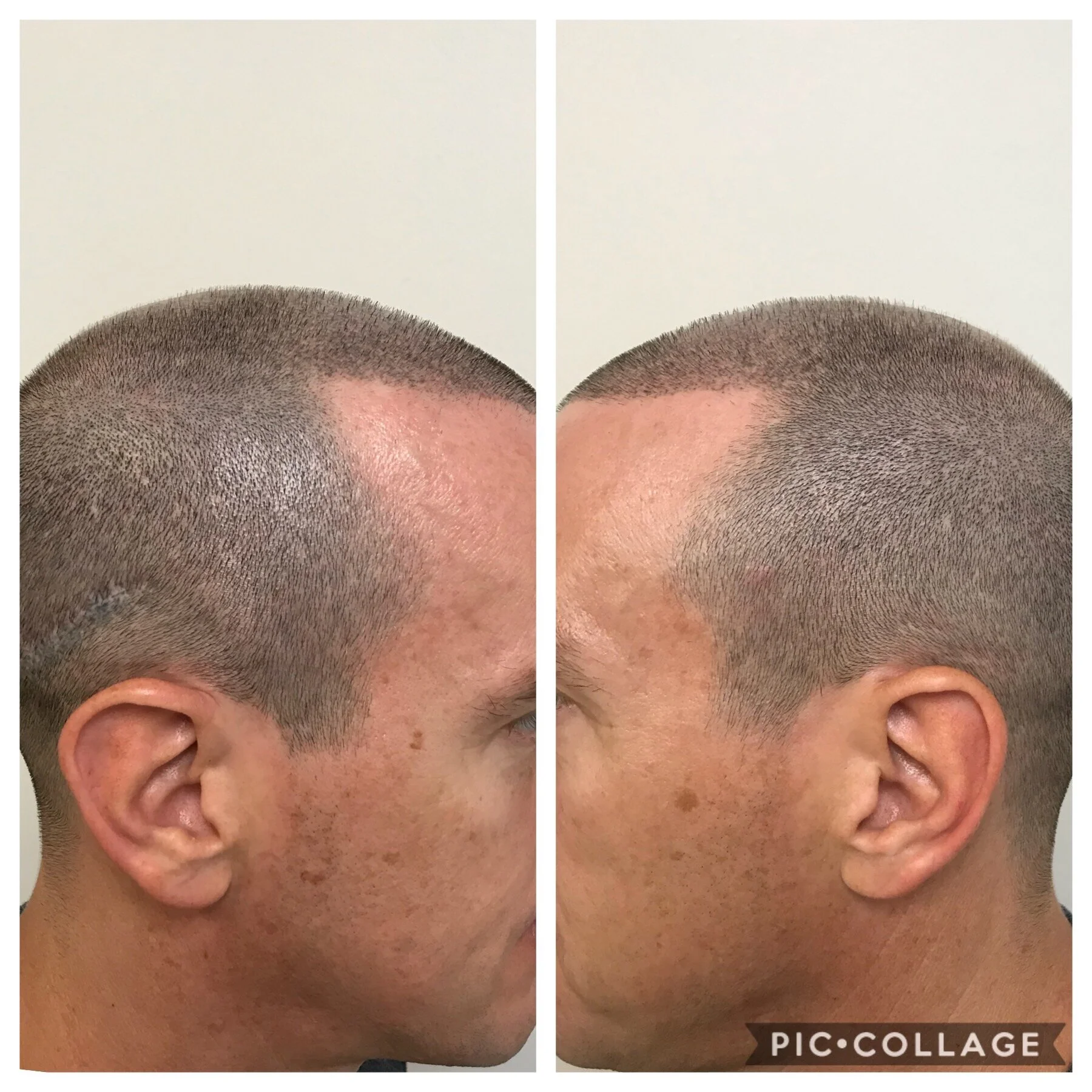 side profiles SMP | thinning and balding hair | tulsa, OK | receding hairline