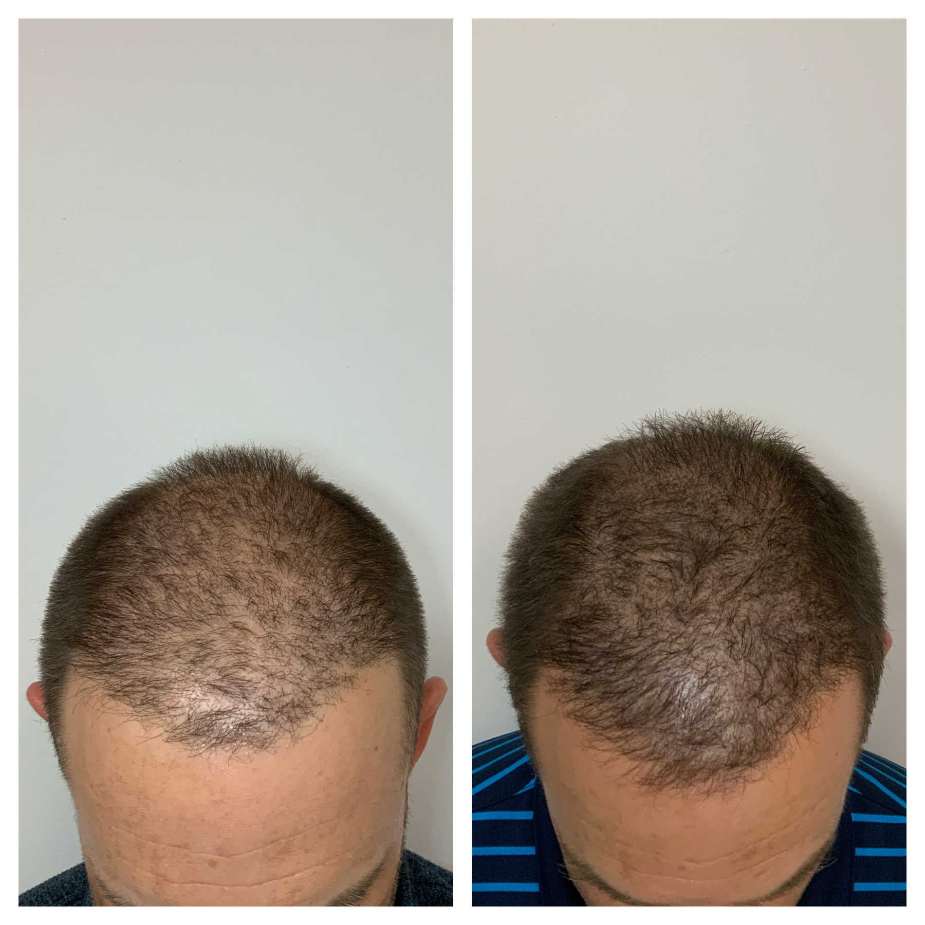thinning hair in front | scalp micropigmentation before and after 