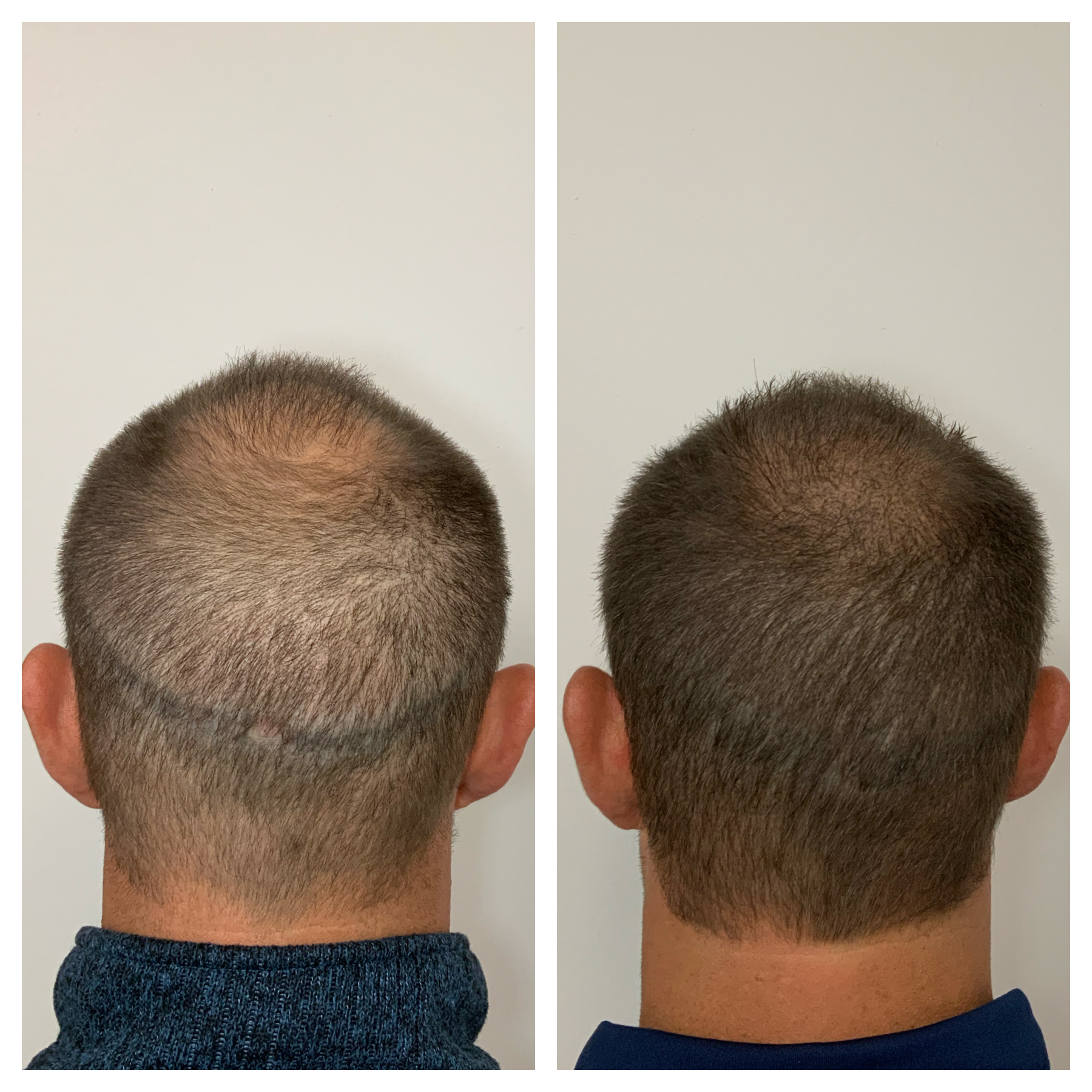 scar camouflage after hair transplant before and afters | primelineokc 