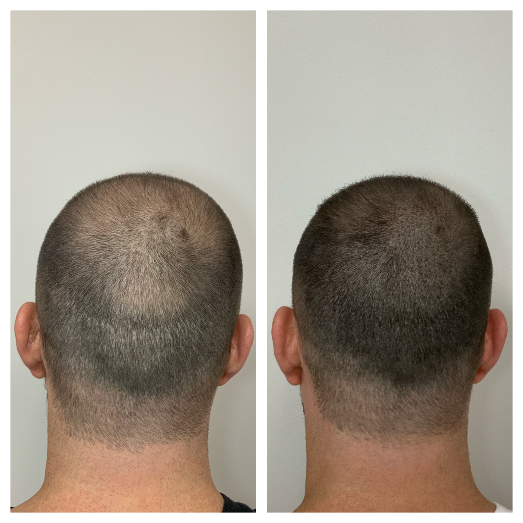 FUE scar camouflage in Oklahoma | SMPOKC | Prime line OKC Scalp Micropigmentation | Hair transplant scar cover up 