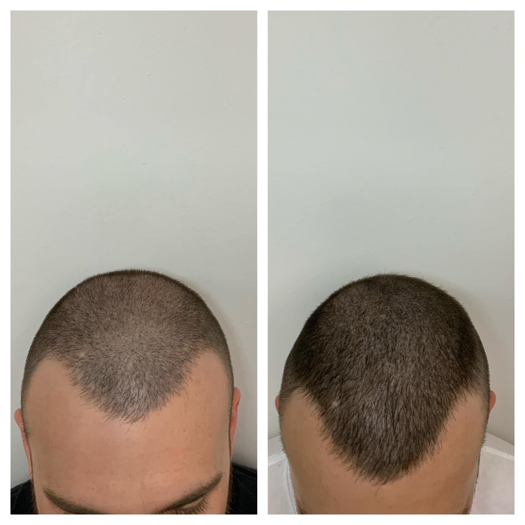 thinning hair cover- up, Oklahoma City, OK | SMPOKC | hair restoration okc 