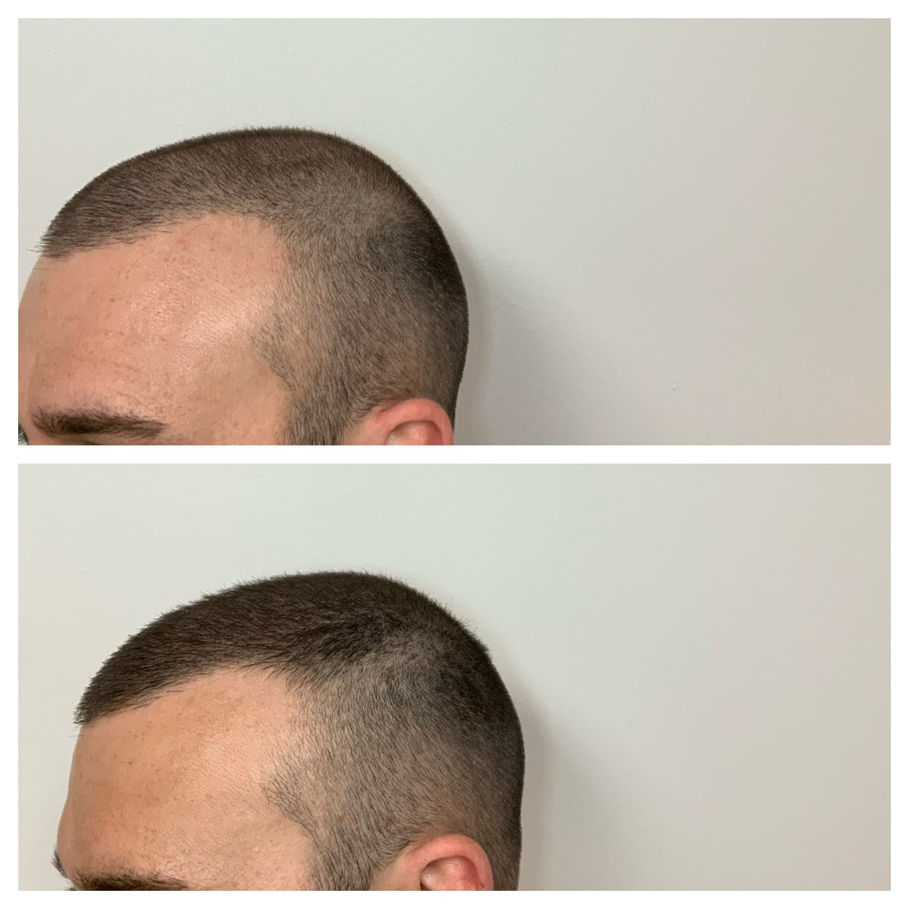 scalp micropigmentation in Oklahoma, hair restoration in oklahoma city, ok, non surgical procedure for thinning or balding hair 