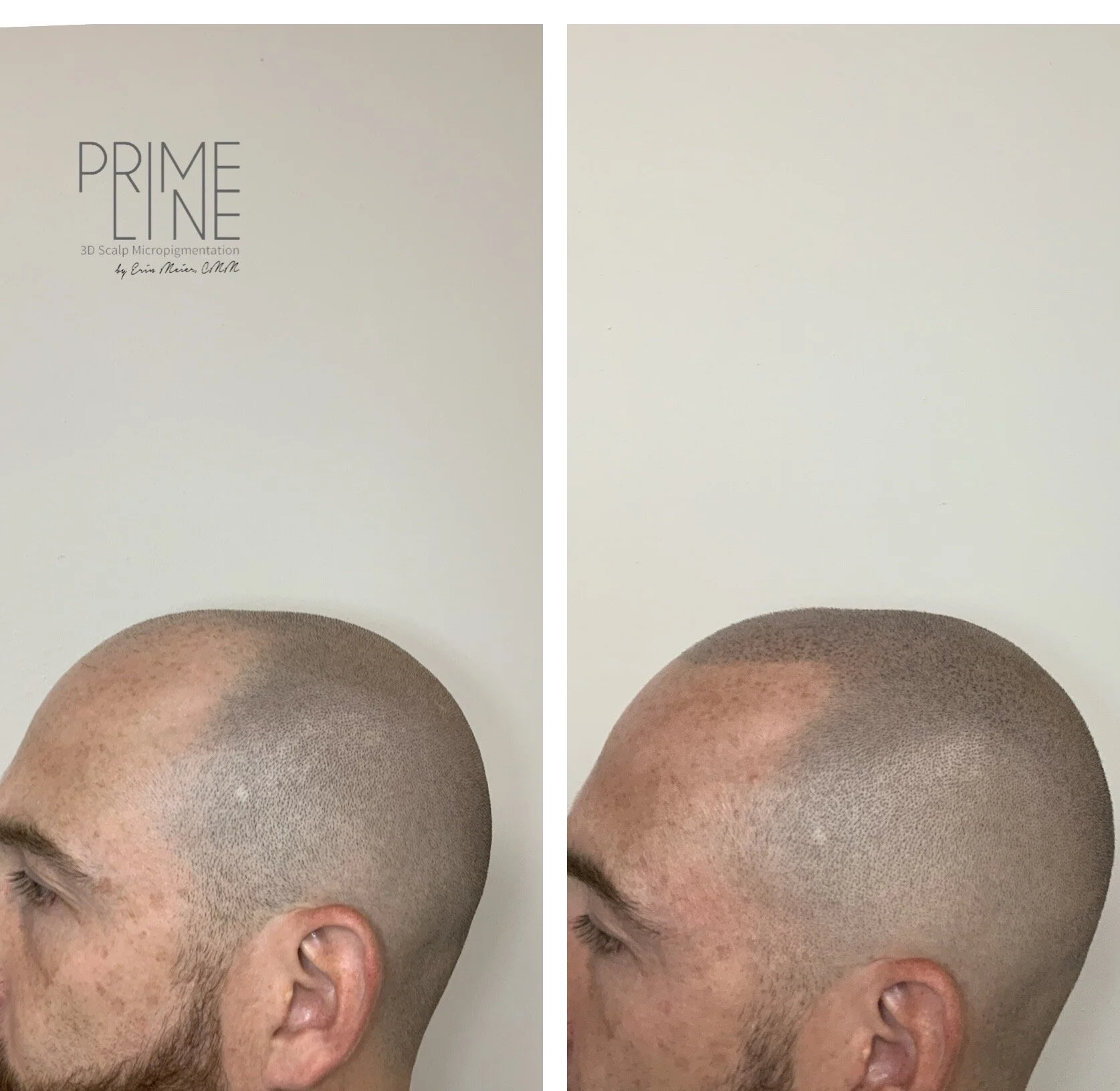 smp okc, thinning hair, scalp tattoo, scalp micropigmentation oklahoma 