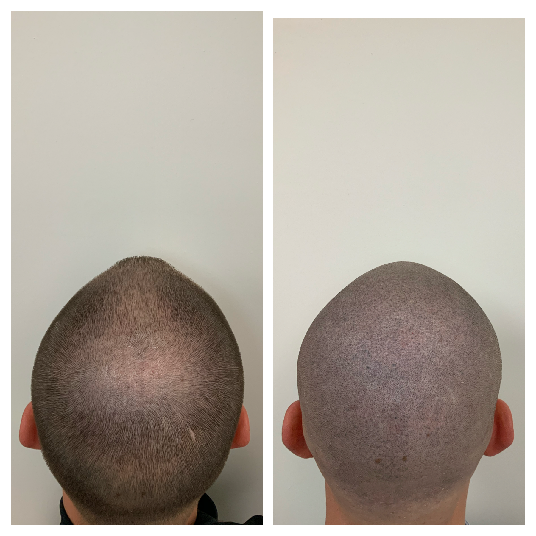 hair restoration, edmond, ok, lawton, ok, thinning hair, balding hair, hair tattoo, Wichita, KS, scalp tattoo, tulsa, ok 