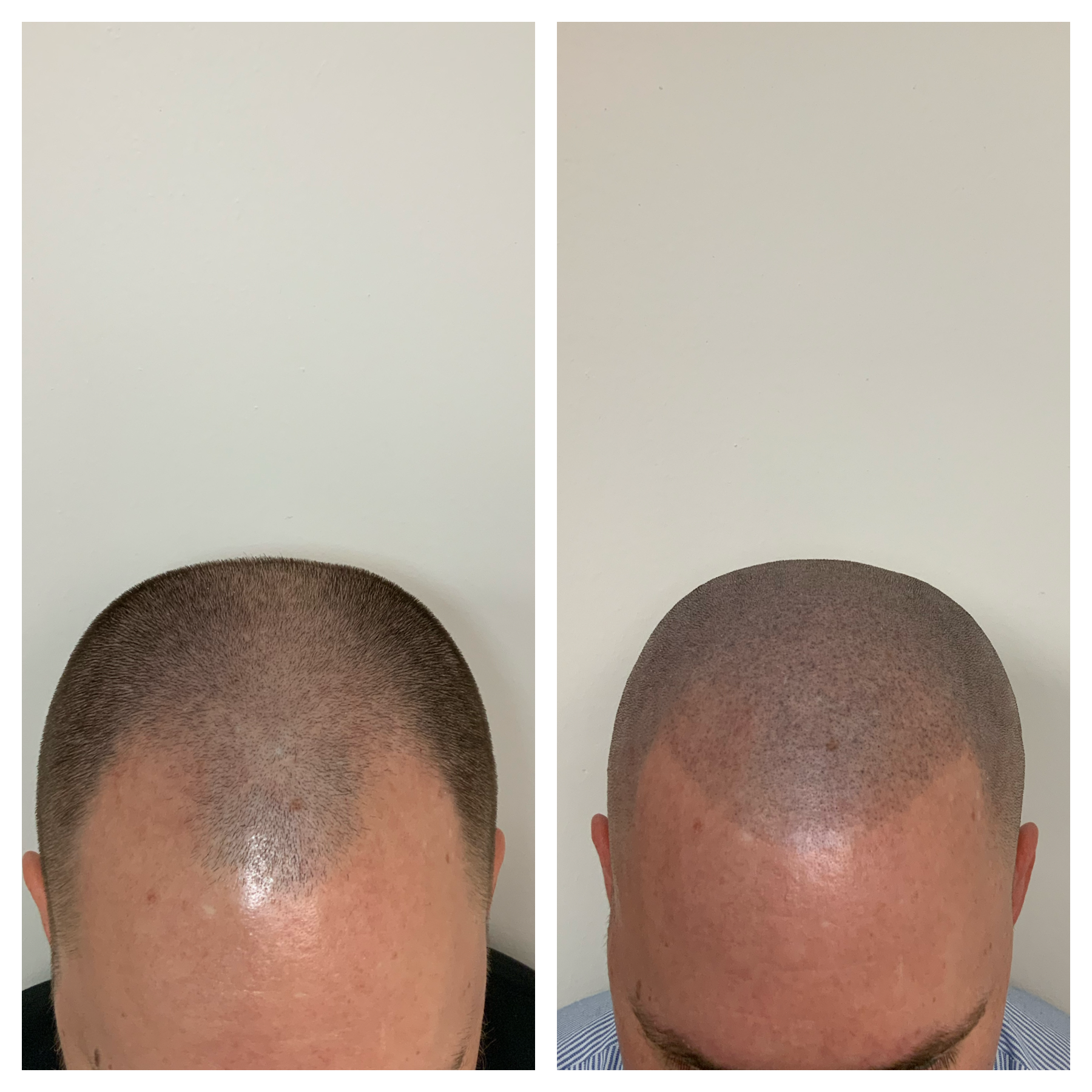 hair loss okc, hair loss Oklahoma, hair club oklahoma, hair club okc 