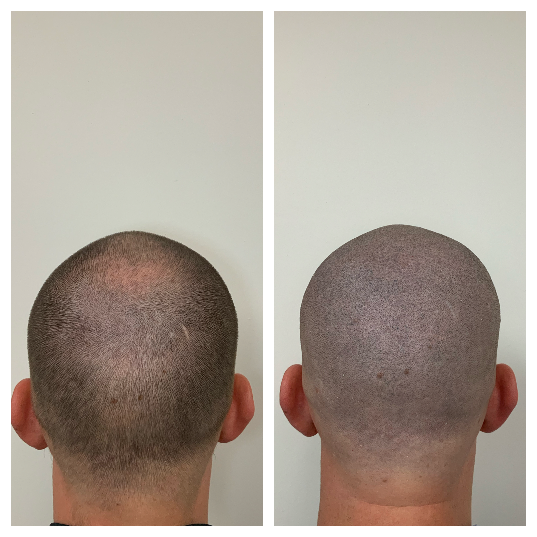prime line okc scalp micropigmentation, men's thinning hair, men's balding hair, men's hair treatment in oklahoma 