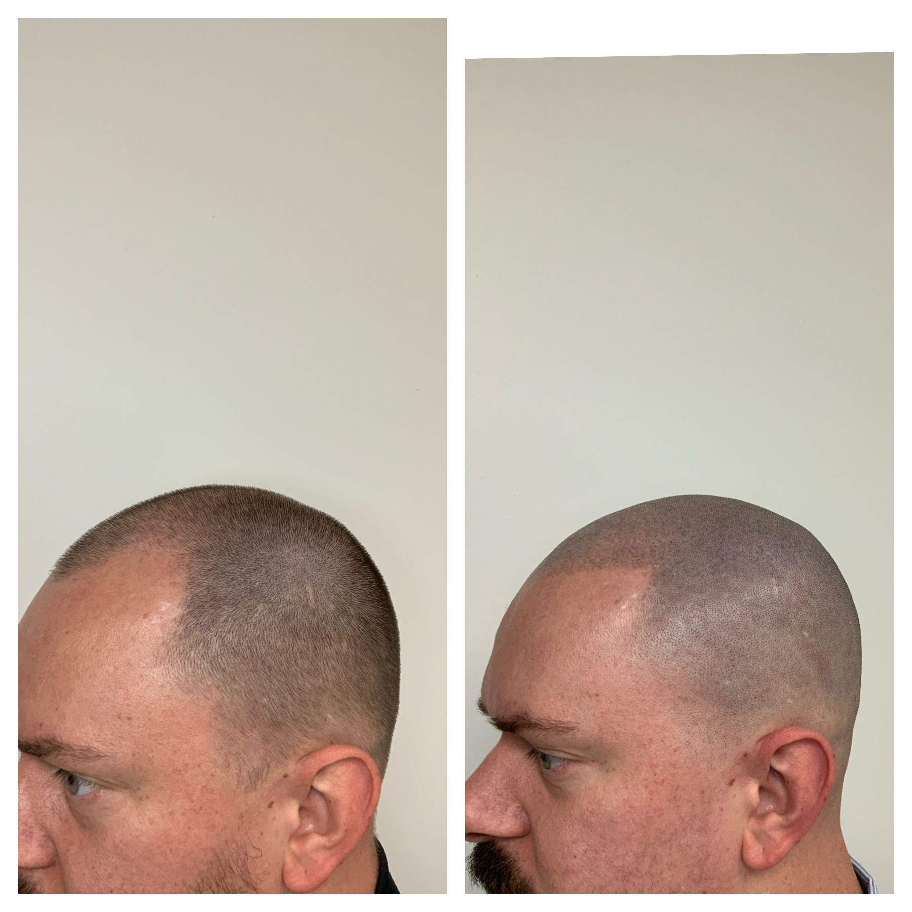 hair loss in Oklahoma, hair loss treatment, thinning and balding hair solution, Tulsa, Ok, Stillwater, OK, Enid, OK, Woodward, OK, Ardmore, OK, Ada, OK 