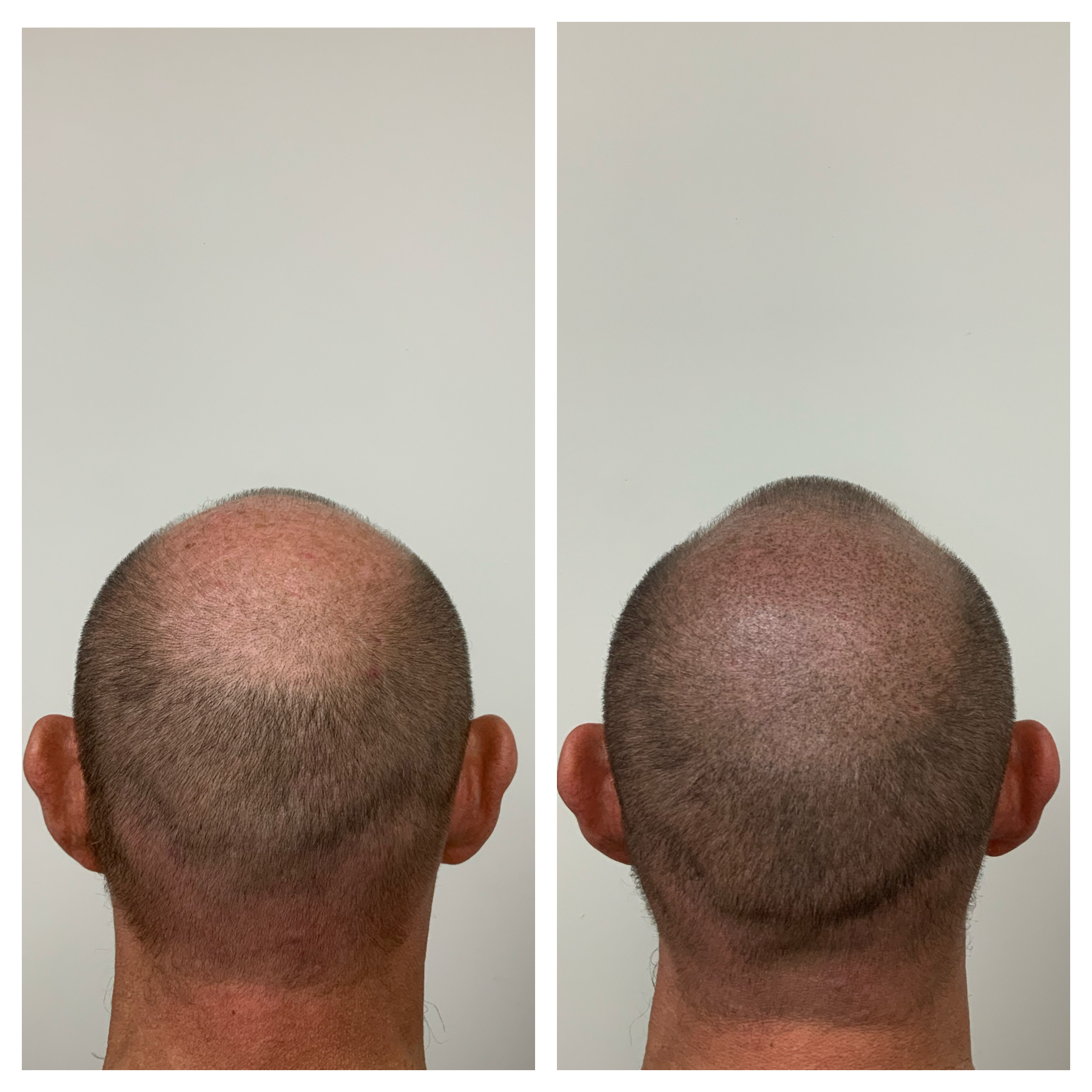 hair transplant, FUE treatment, hair restoration in Oklahoma, OKC, OKC Metro 