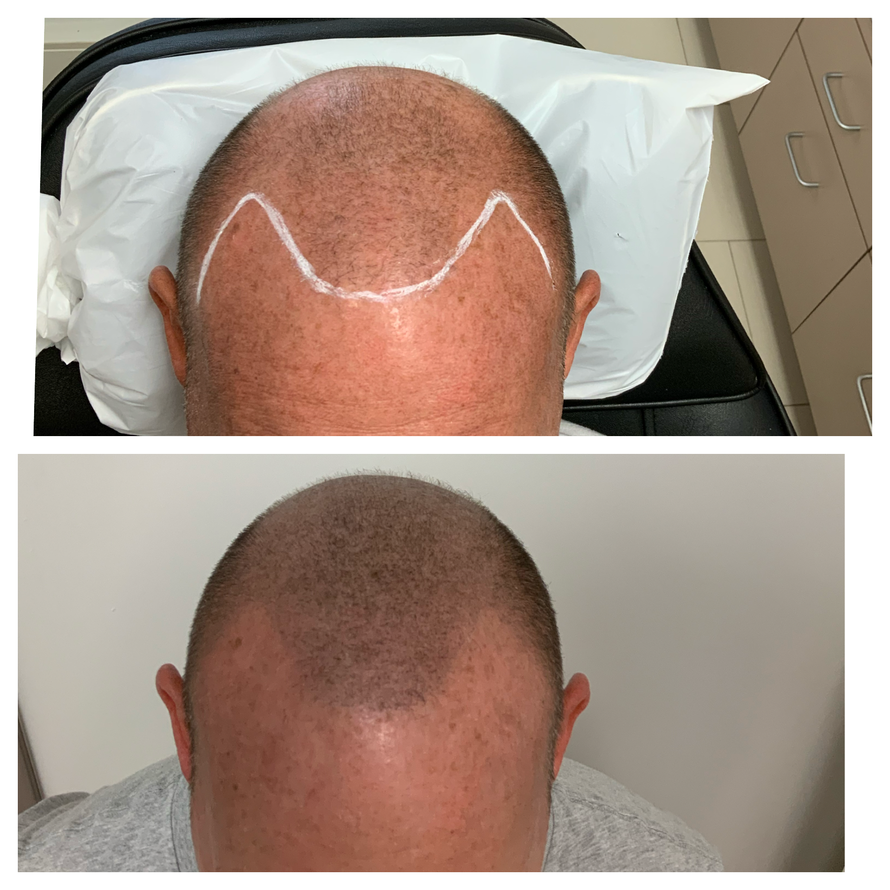Hairline treatment, new hairline, men of Oklahoma, hair treatment options, hair club 