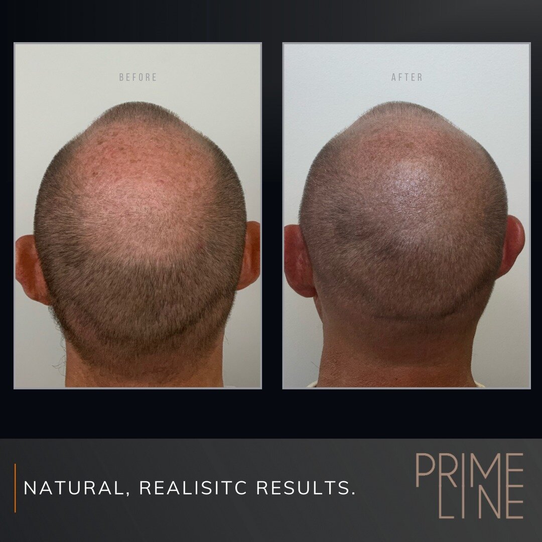 Before and after shots speak volumes &ndash; watch as thinning hair becomes a thing of the past. Boost your self-esteem and redefine your look with tailored SMP treatments. Confidence begins with a confident scalp! #SMPJourney #ConfidenceBoost #hairt