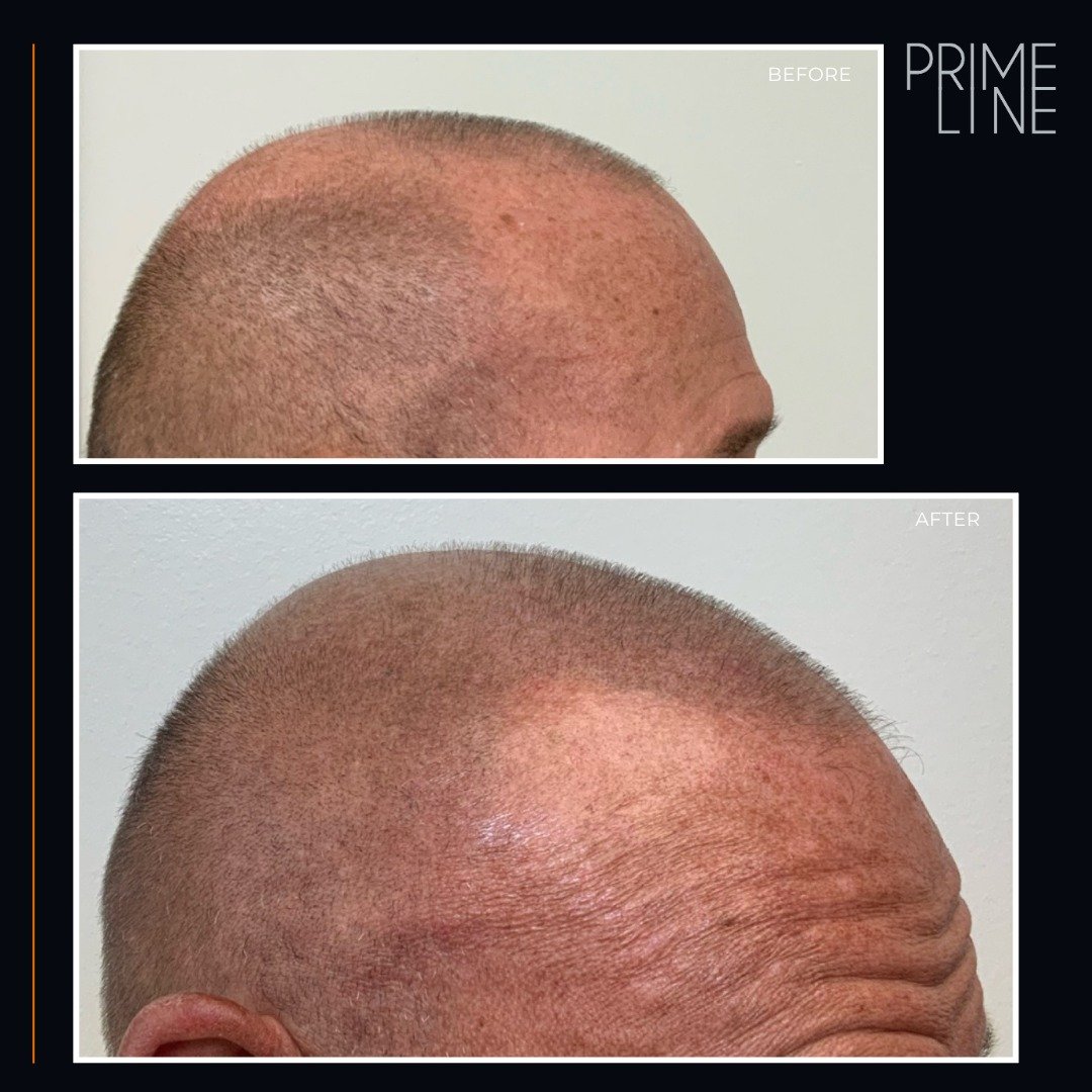 If you're looking for a non-surgical solution to hair loss that delivers genuine-looking results, Scalp Micropigmentation has got you covered! Ready to embrace a new look? Book your consultation today! 📞💫 #ScalpMicropigmentation #RealResults #HairL